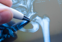 Do You Need A Hip Replacement?